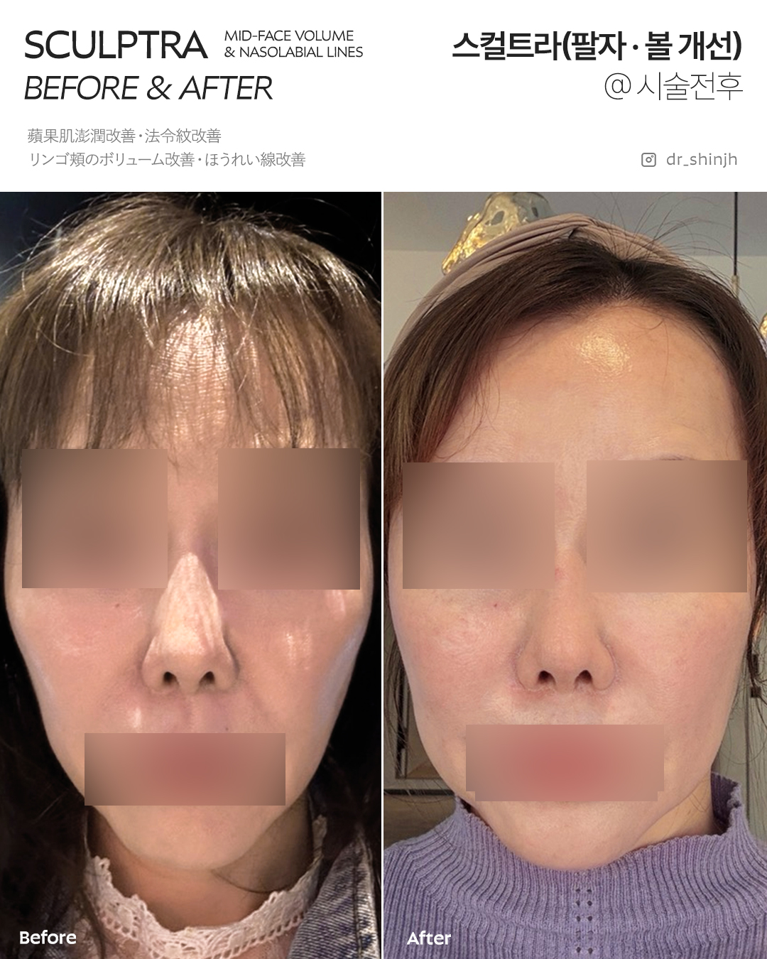 FLORIA Clinic 术前术后照片